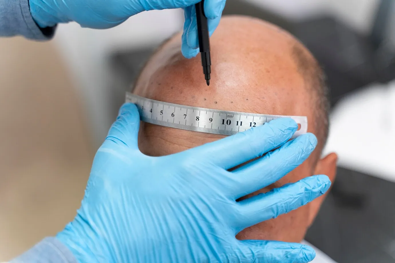 Understanding Hair Transplant Surgery